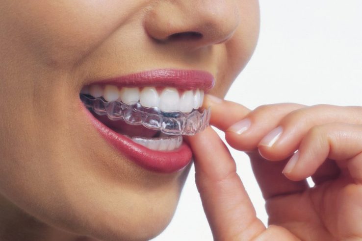 Invisalign