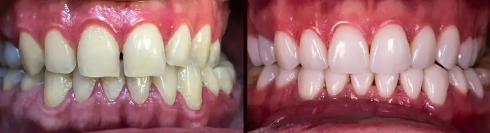 Porcelain Veneers Driffield
