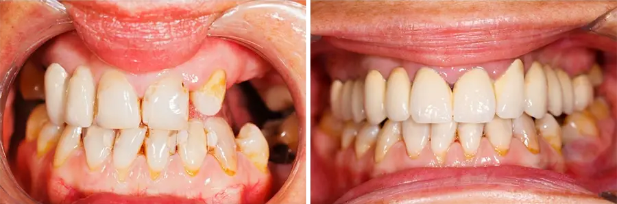 Dental Bridges Driffield